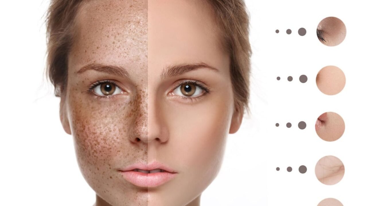 hyperpigmentation laser treatment